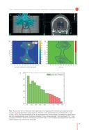Рекомендации по проведению стереотаксической лучевой терапии на аппарате 