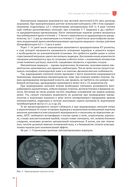 Рекомендации по проведению стереотаксической лучевой терапии на аппарате 