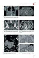 Рекомендации по проведению стереотаксической лучевой терапии на аппарате 