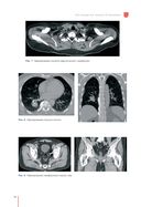 Рекомендации по проведению стереотаксической лучевой терапии на аппарате 